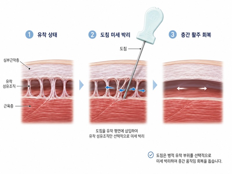유착된 상태에서 도침으로 유착 섬유조직만 미세하게 나눈 뒤, 층과 층이 다시 미끄러지게 되는 세 단계 그림